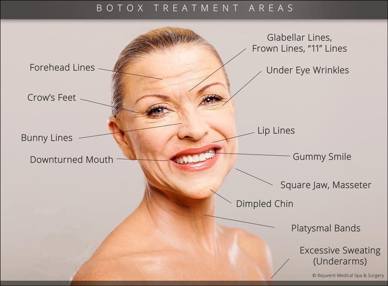 What is Botox Treatment? Is it Safe? Dentist in Leeds