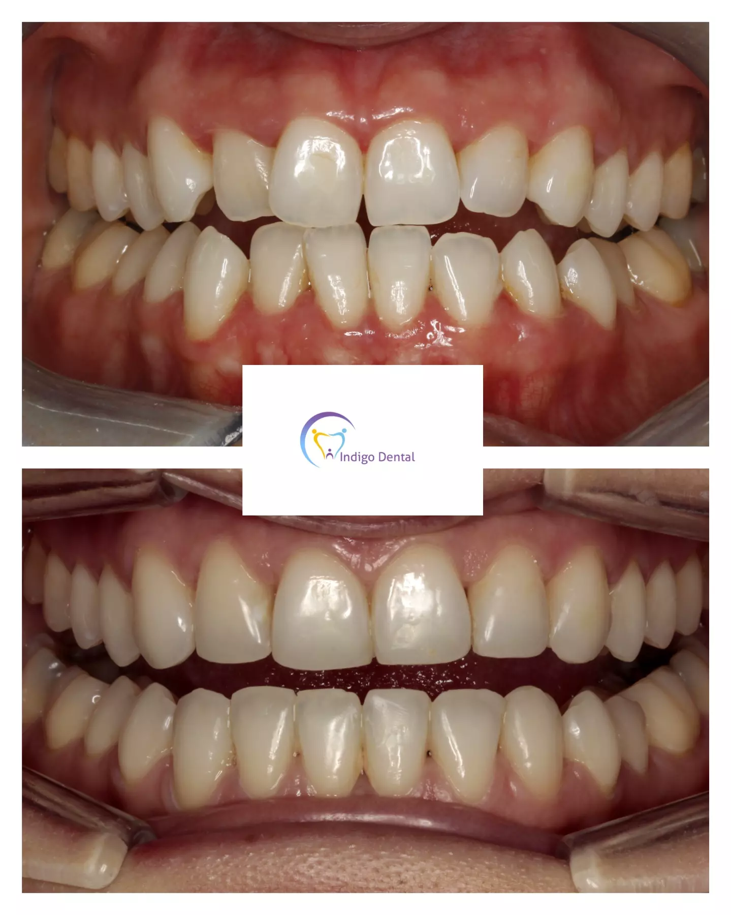 Invisible braces Leeds Dentist in Leeds